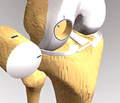 knee-articular-cartilage-repair
