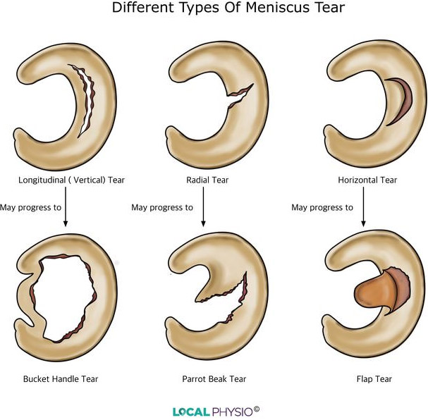 Meniscus Tears Sports Medicine Doctor Mesa AZ Orthopedic Surgeon Meniscus Tears Sports Medicine Doctor Mesa AZ Orthopedic Surgeon